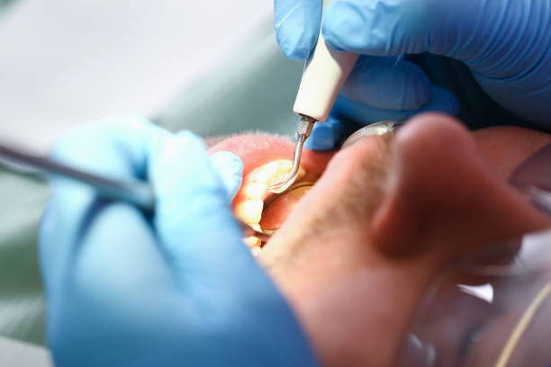 Best Emergency Tooth Extraction in Mckenzie, TN